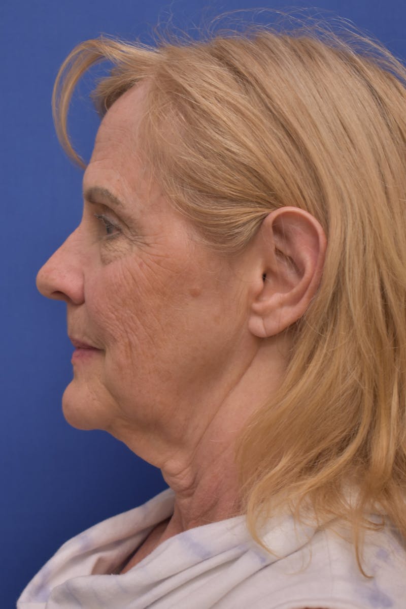 Facelift Before & After Gallery - Patient 241237 - Image 7