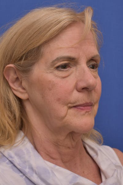 Facelift Before & After Gallery - Patient 241237 - Image 1