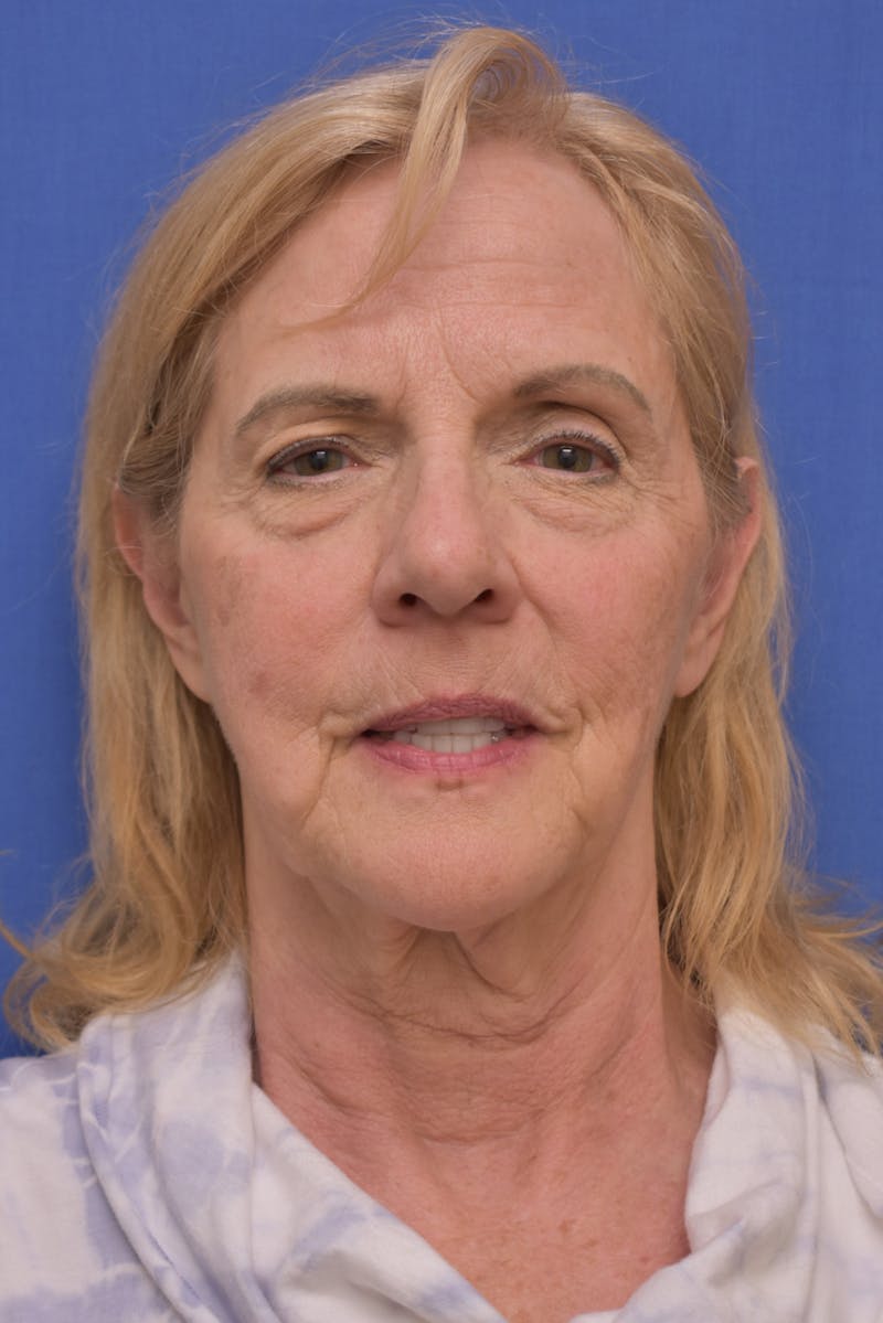 Facelift Before & After Gallery - Patient 241237 - Image 5