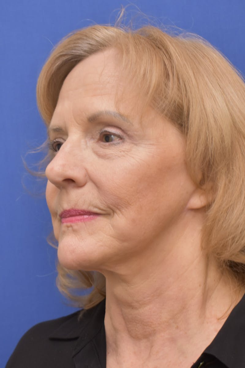 Facelift Before & After Gallery - Patient 241237 - Image 4