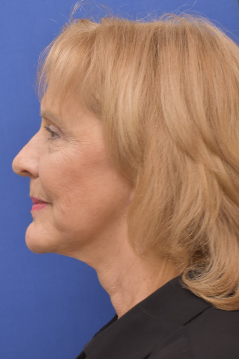 Facelift Before & After Gallery - Patient 241237 - Image 8