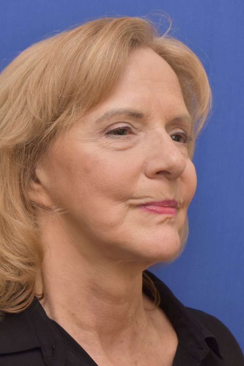 Facelift Before & After Gallery - Patient 241237 - Image 2