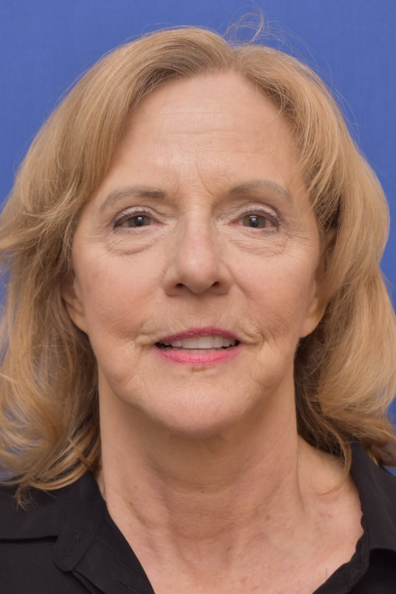 Facelift Before & After Gallery - Patient 241237 - Image 6