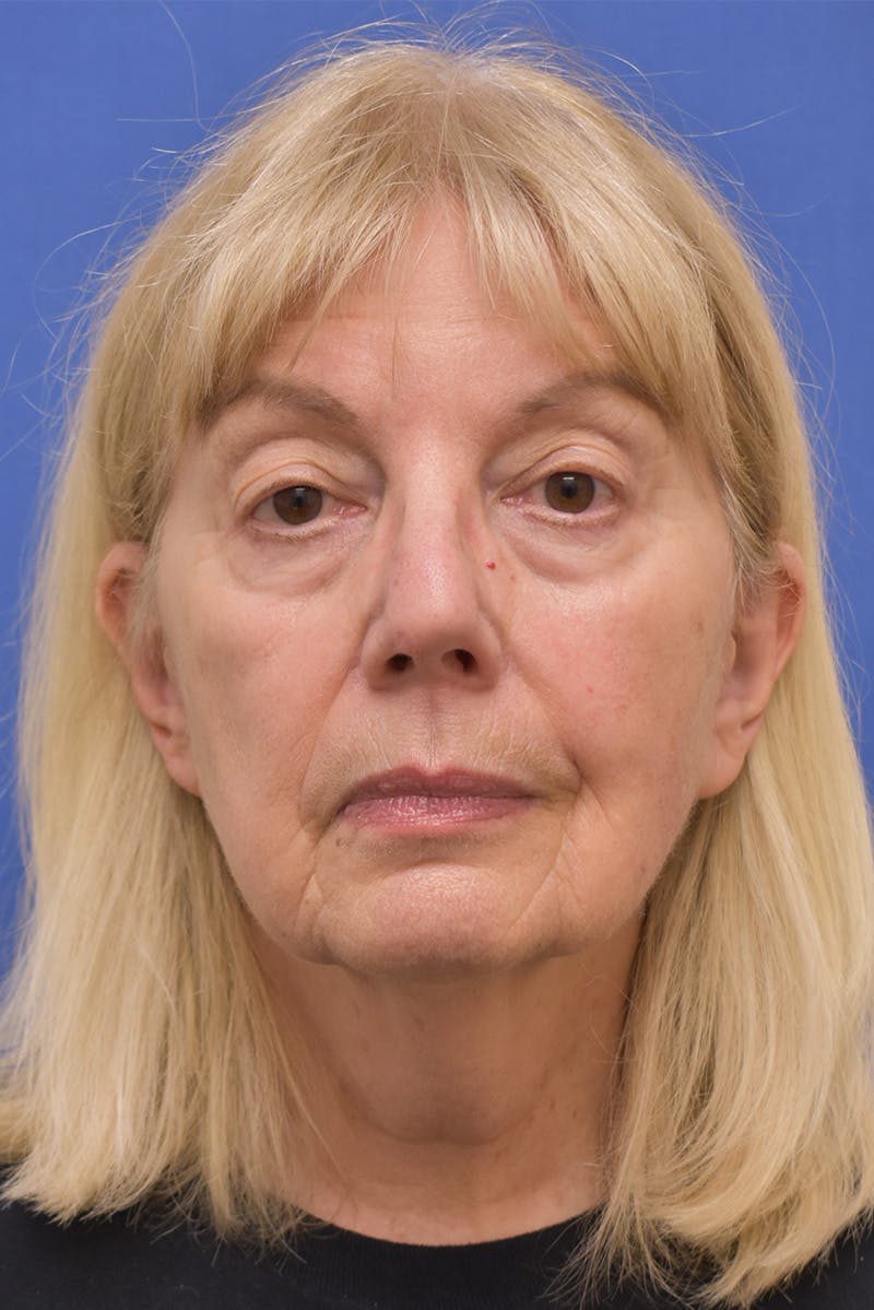 Facelift Before & After Gallery - Patient 198012 - Image 5