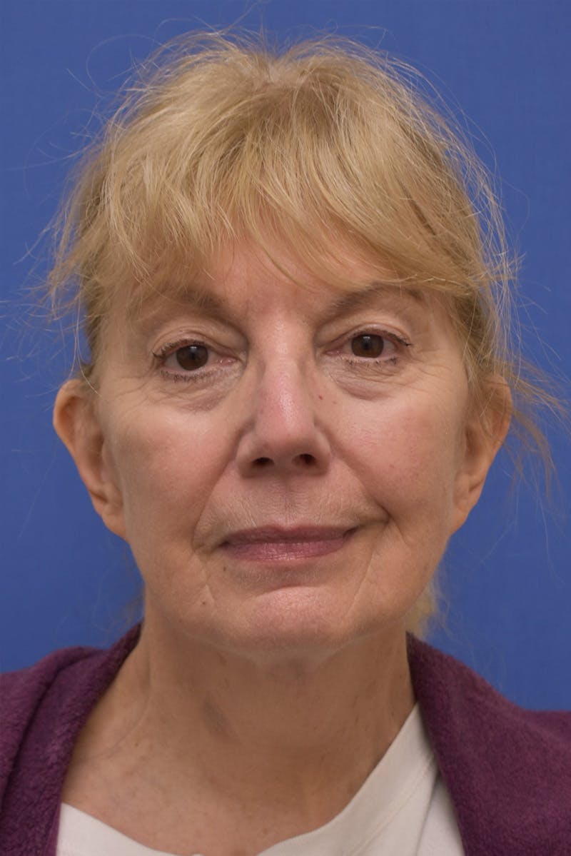 Facelift Before & After Gallery - Patient 198012 - Image 6
