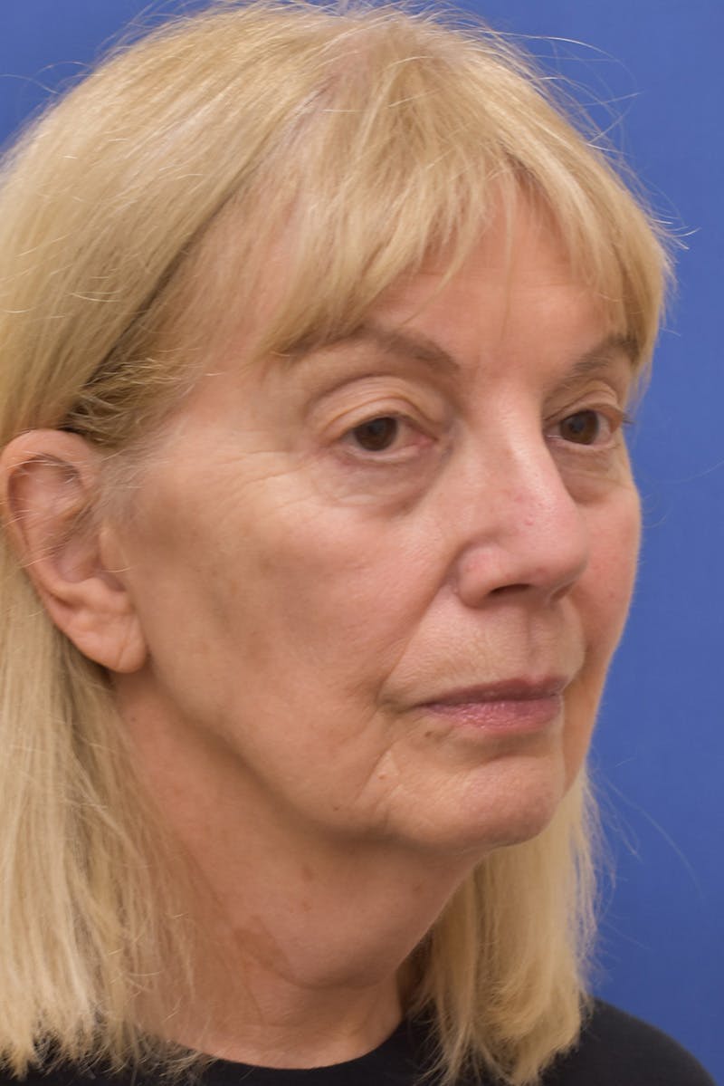Facelift Before & After Gallery - Patient 198012 - Image 1