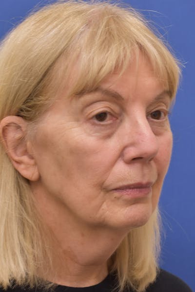 Necklift Before & After Gallery - Patient 296774 - Image 1