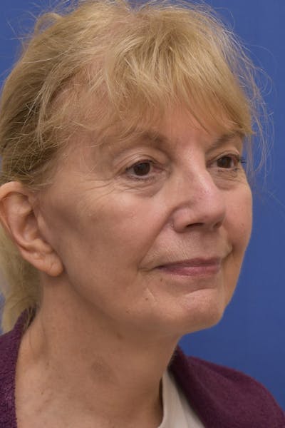 Facelift Before & After Gallery - Patient 198012 - Image 2