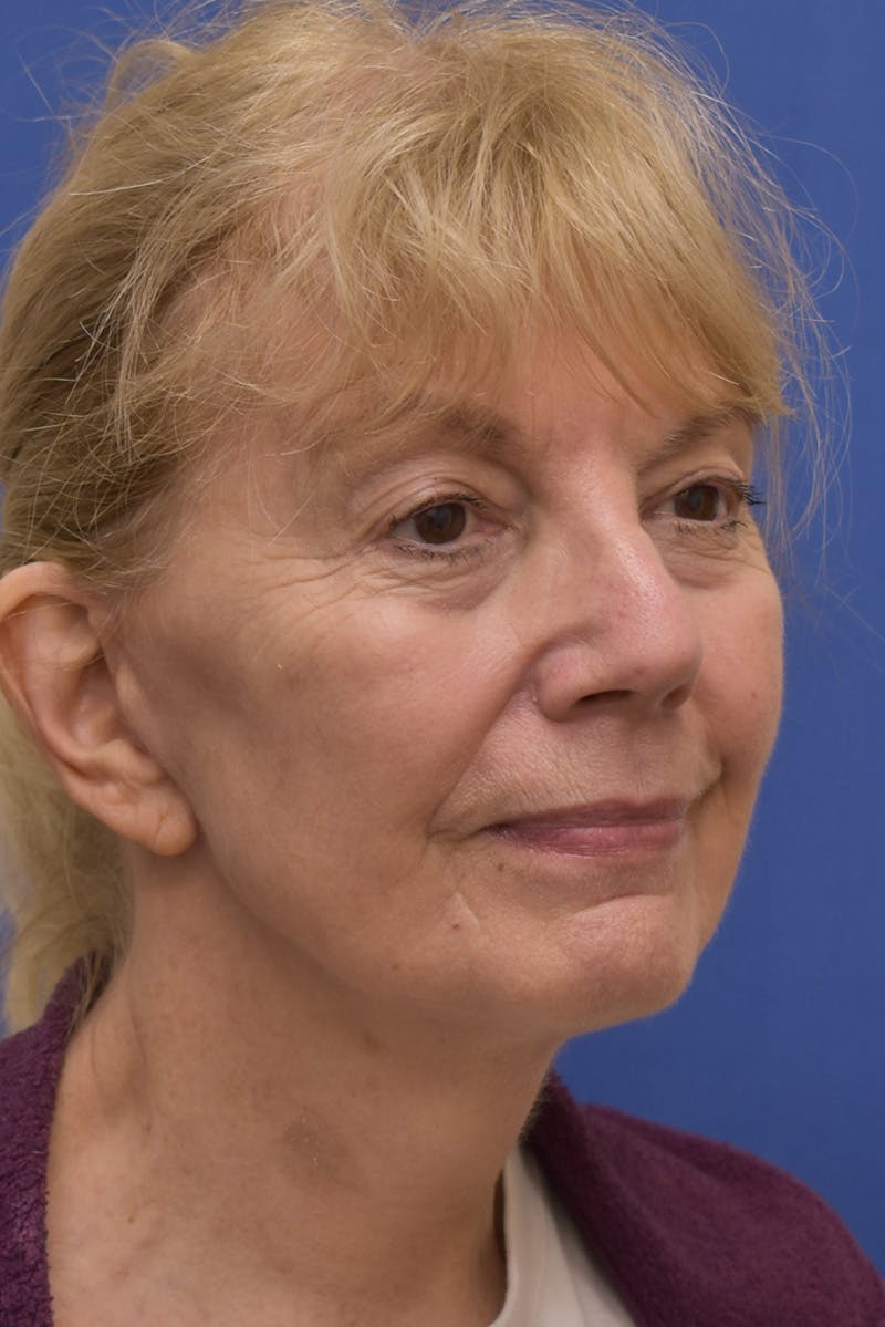 Facelift Before & After Gallery - Patient 198012 - Image 2