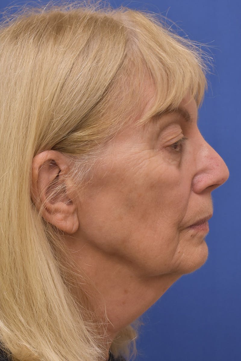 Facelift Before & After Gallery - Patient 198012 - Image 3