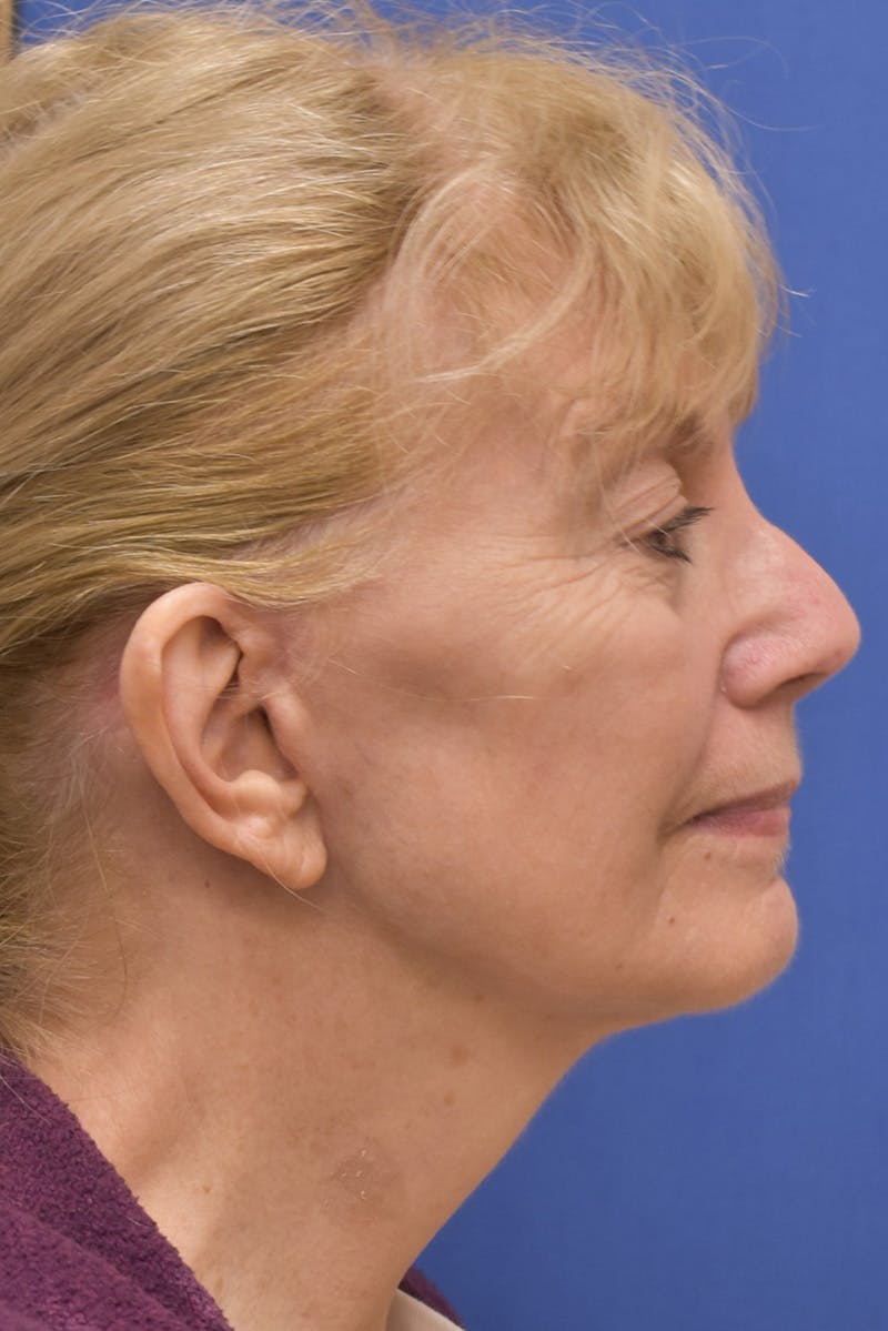 Facelift Before & After Gallery - Patient 198012 - Image 4