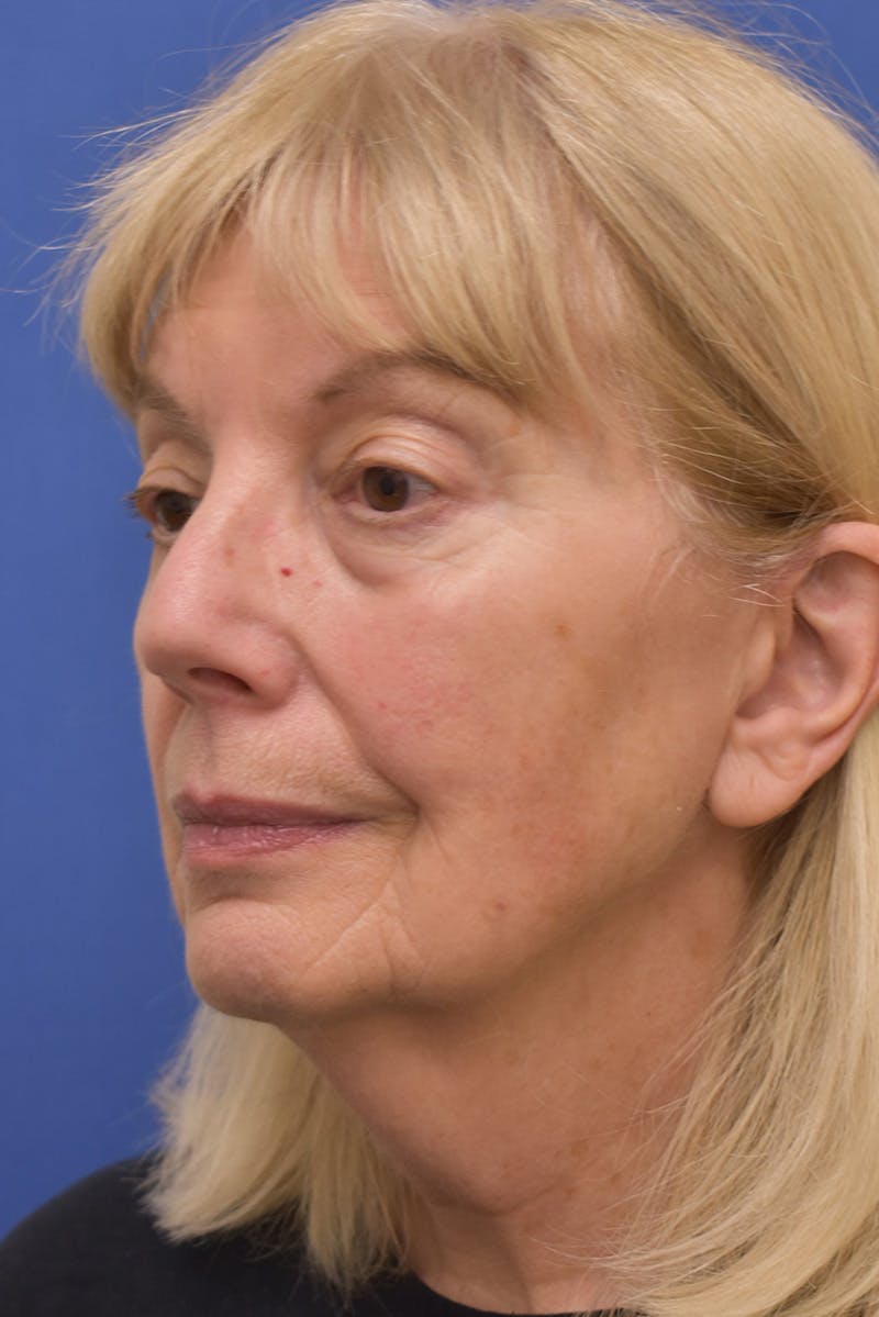 Facelift Before & After Gallery - Patient 198012 - Image 7