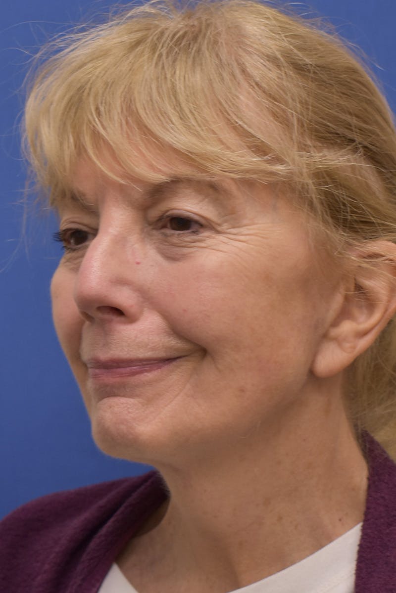 Facelift Before & After Gallery - Patient 198012 - Image 8