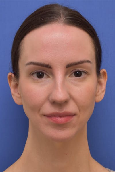 Chin Augmentation Before & After Gallery - Patient 215632 - Image 1