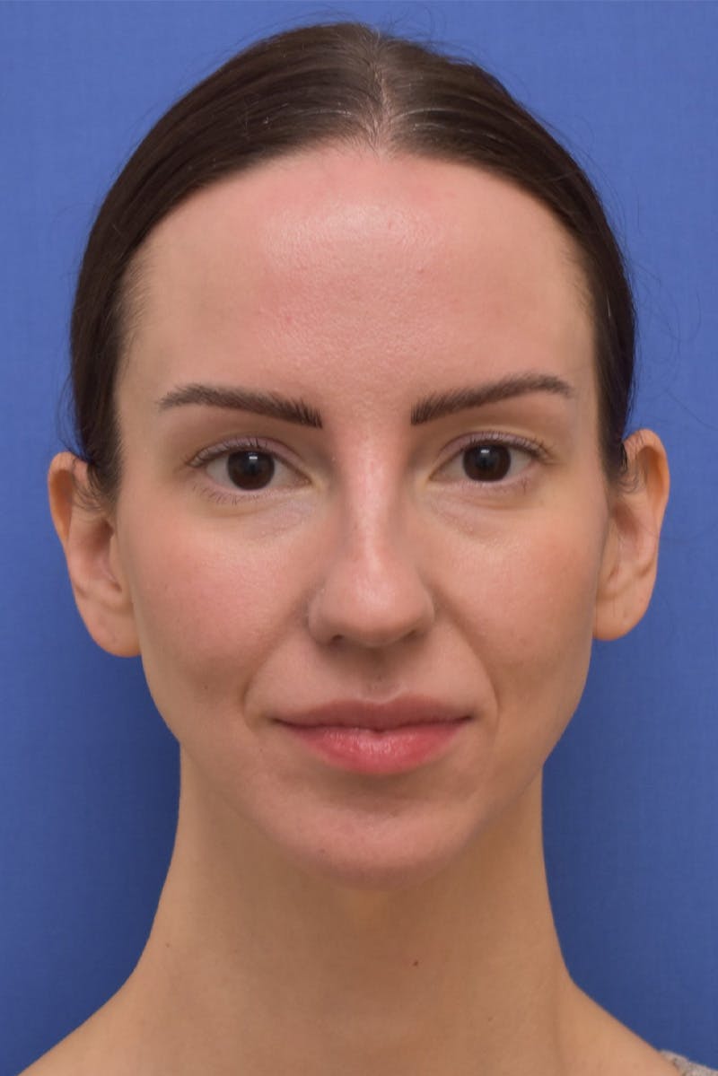 Facelift Before & After Gallery - Patient 533737 - Image 5