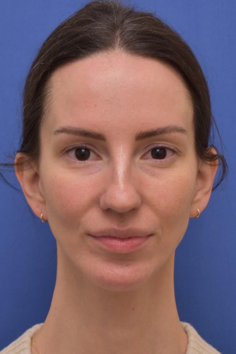 Facelift Before & After Gallery - Patient 533737 - Image 6