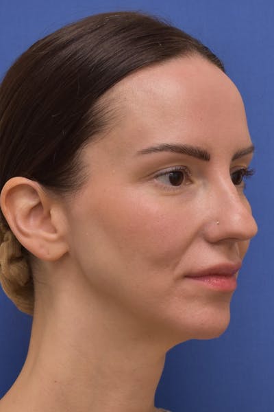 Facelift Before & After Gallery - Patient 533737 - Image 1