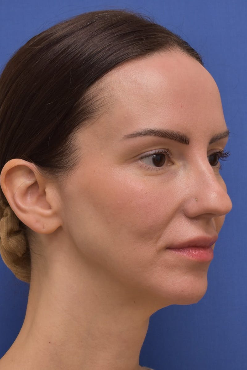 Facelift Before & After Gallery - Patient 533737 - Image 1