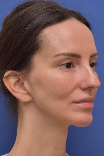 Facelift Before & After Gallery - Patient 533737 - Image 2