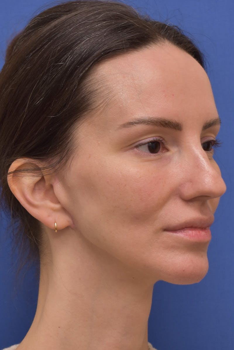 Facelift Before & After Gallery - Patient 533737 - Image 2