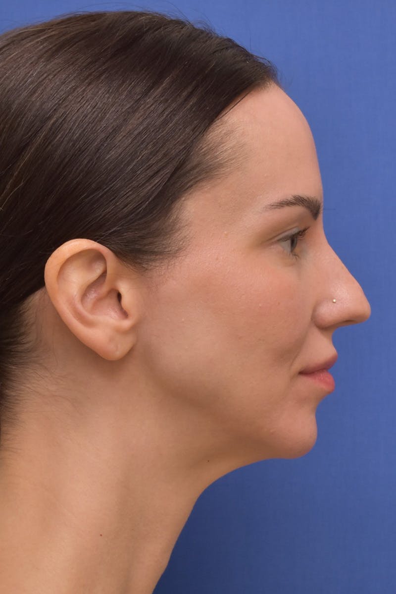 Facelift Before & After Gallery - Patient 533737 - Image 3