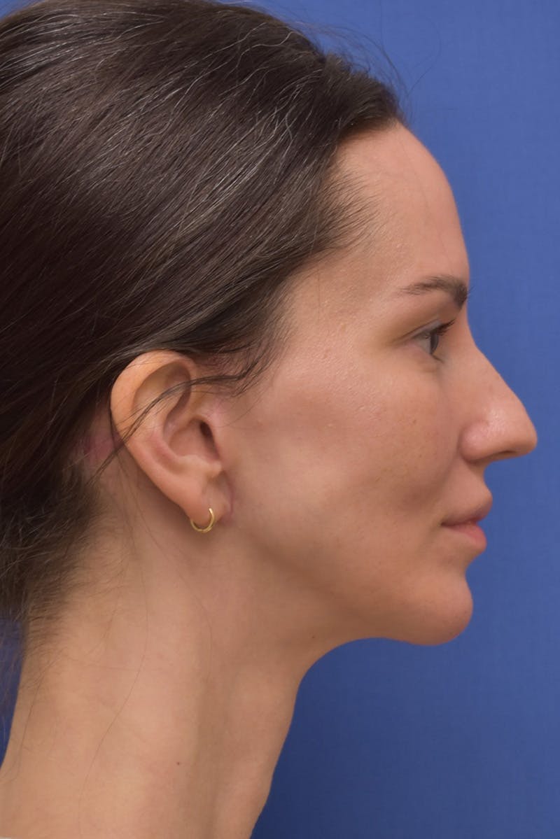 Facelift Before & After Gallery - Patient 533737 - Image 4