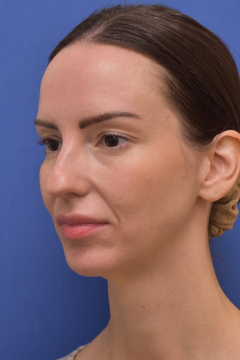 Facelift Before & After Gallery - Patient 533737 - Image 7