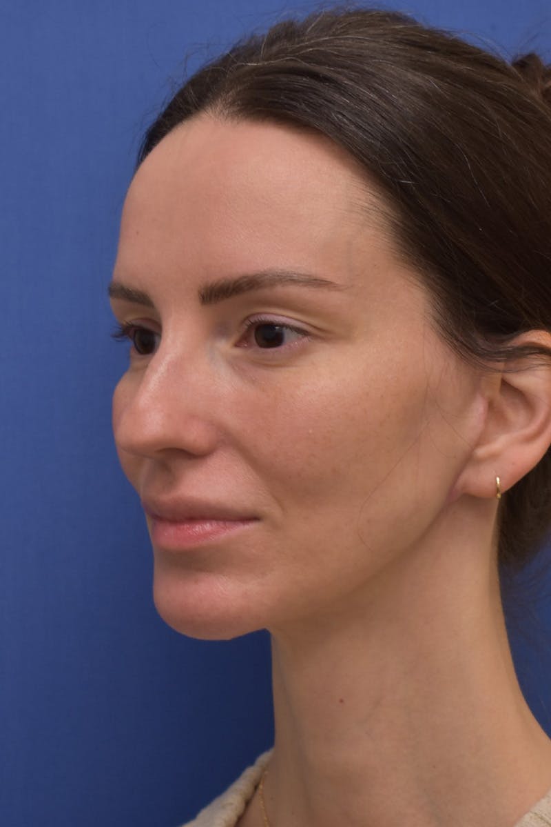 Facelift Before & After Gallery - Patient 533737 - Image 8