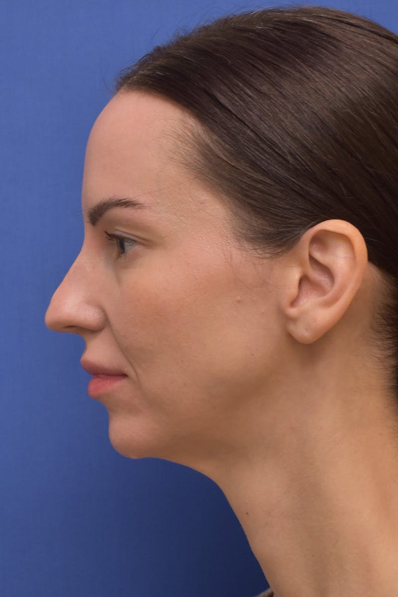 Facelift Before & After Gallery - Patient 533737 - Image 9