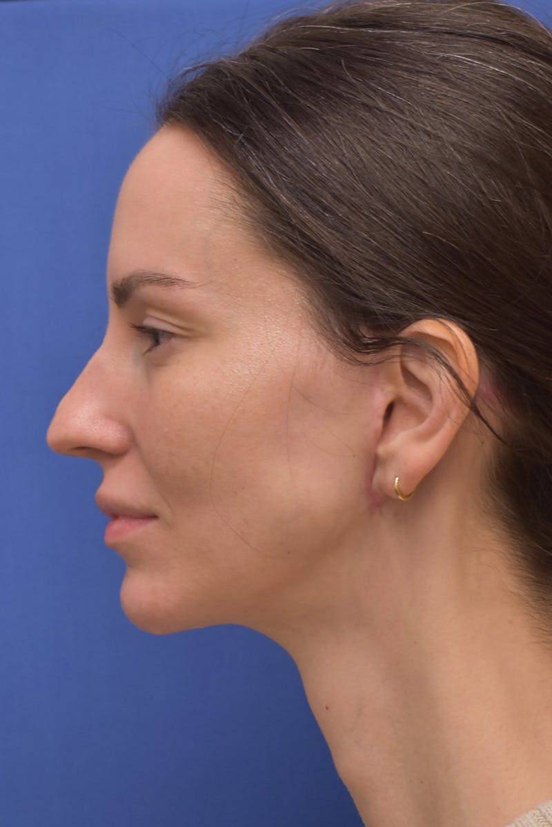 Facelift Before & After Gallery - Patient 533737 - Image 10