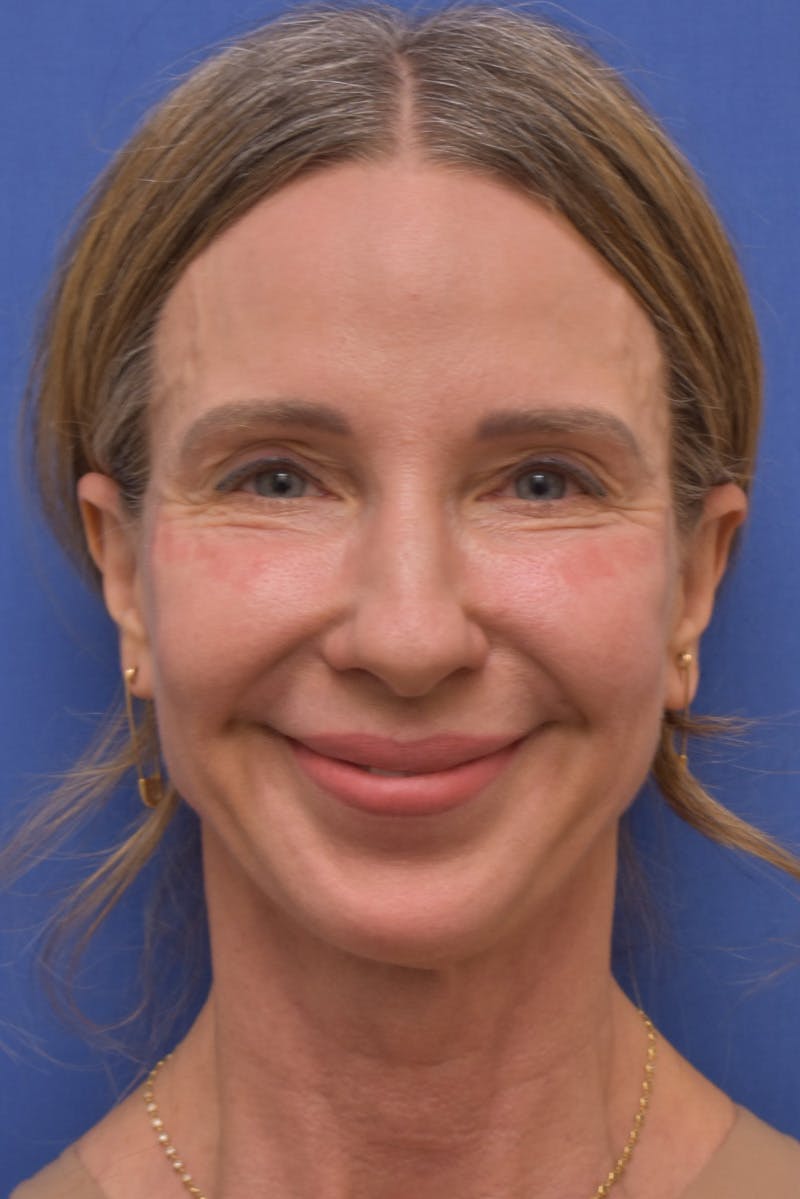 Necklift Before & After Gallery - Patient 408053 - Image 5