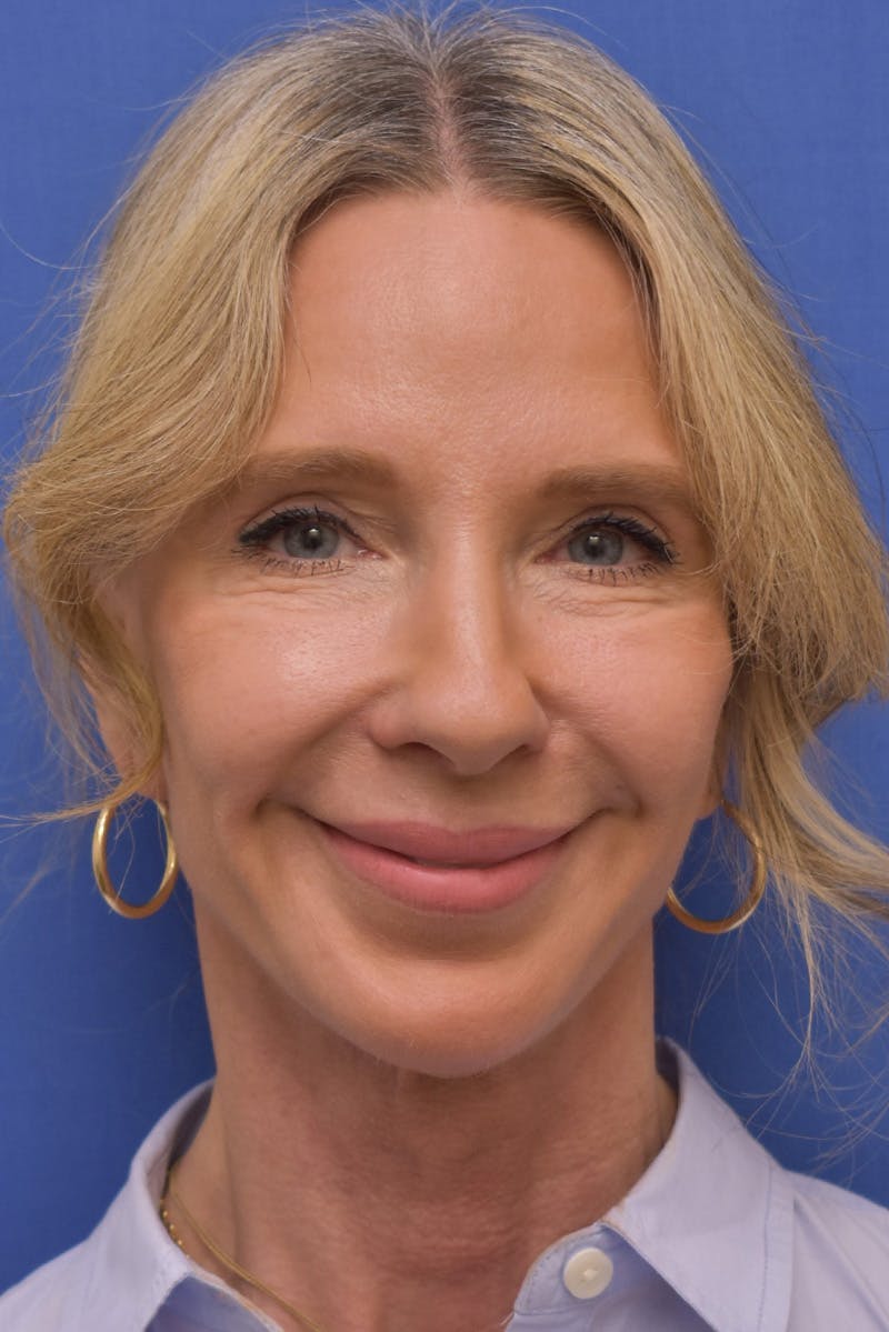 Necklift Before & After Gallery - Patient 408053 - Image 6