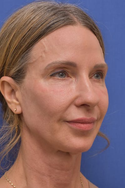 Facelift Before & After Gallery - Patient 407369 - Image 1