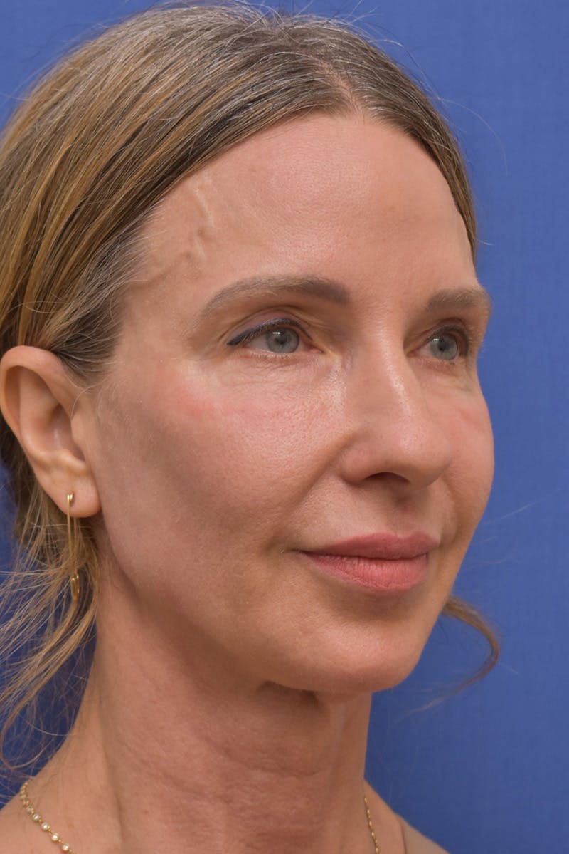 Necklift Before & After Gallery - Patient 408053 - Image 1