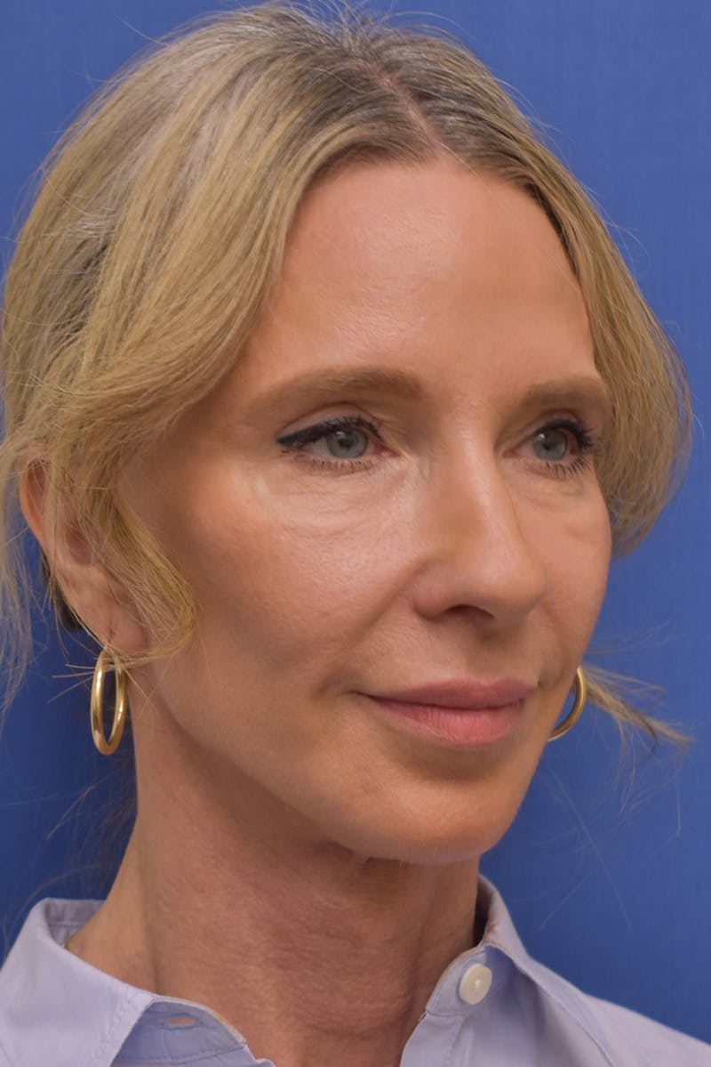Necklift Before & After Gallery - Patient 408053 - Image 2