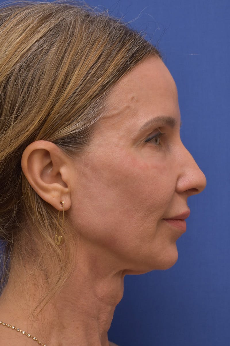 Necklift Before & After Gallery - Patient 408053 - Image 7