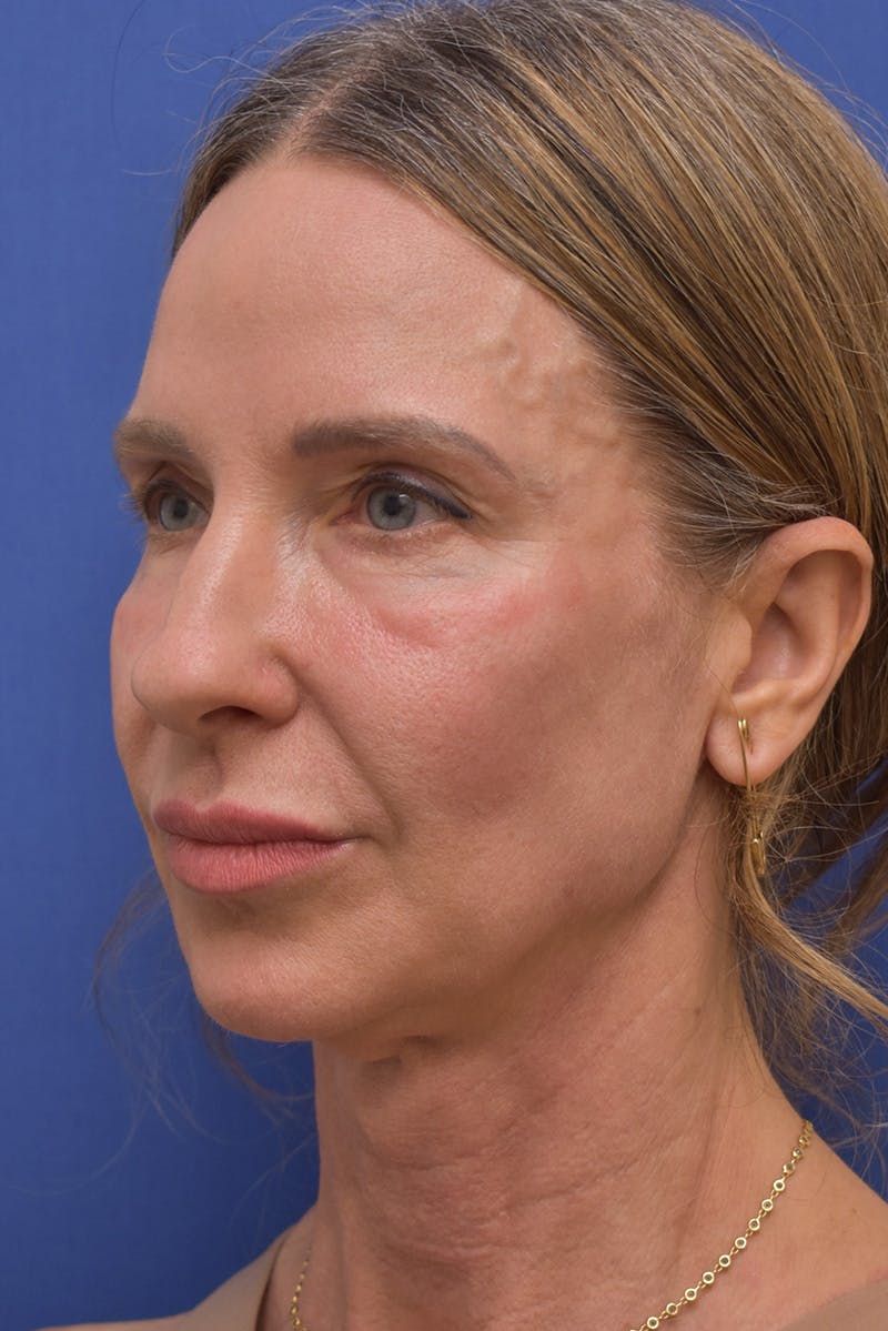 Necklift Before & After Gallery - Patient 408053 - Image 9