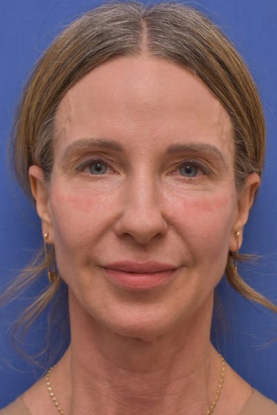 Blepharoplasty Before & After Gallery - Patient 426672 - Image 1