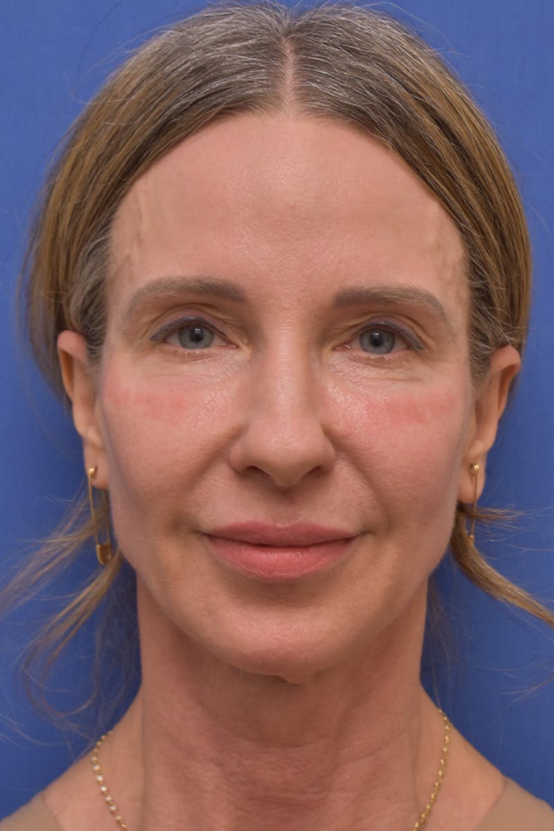 Necklift Before & After Gallery - Patient 408053 - Image 3