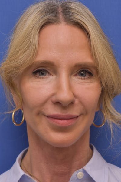 Blepharoplasty Before & After Gallery - Patient 426672 - Image 2