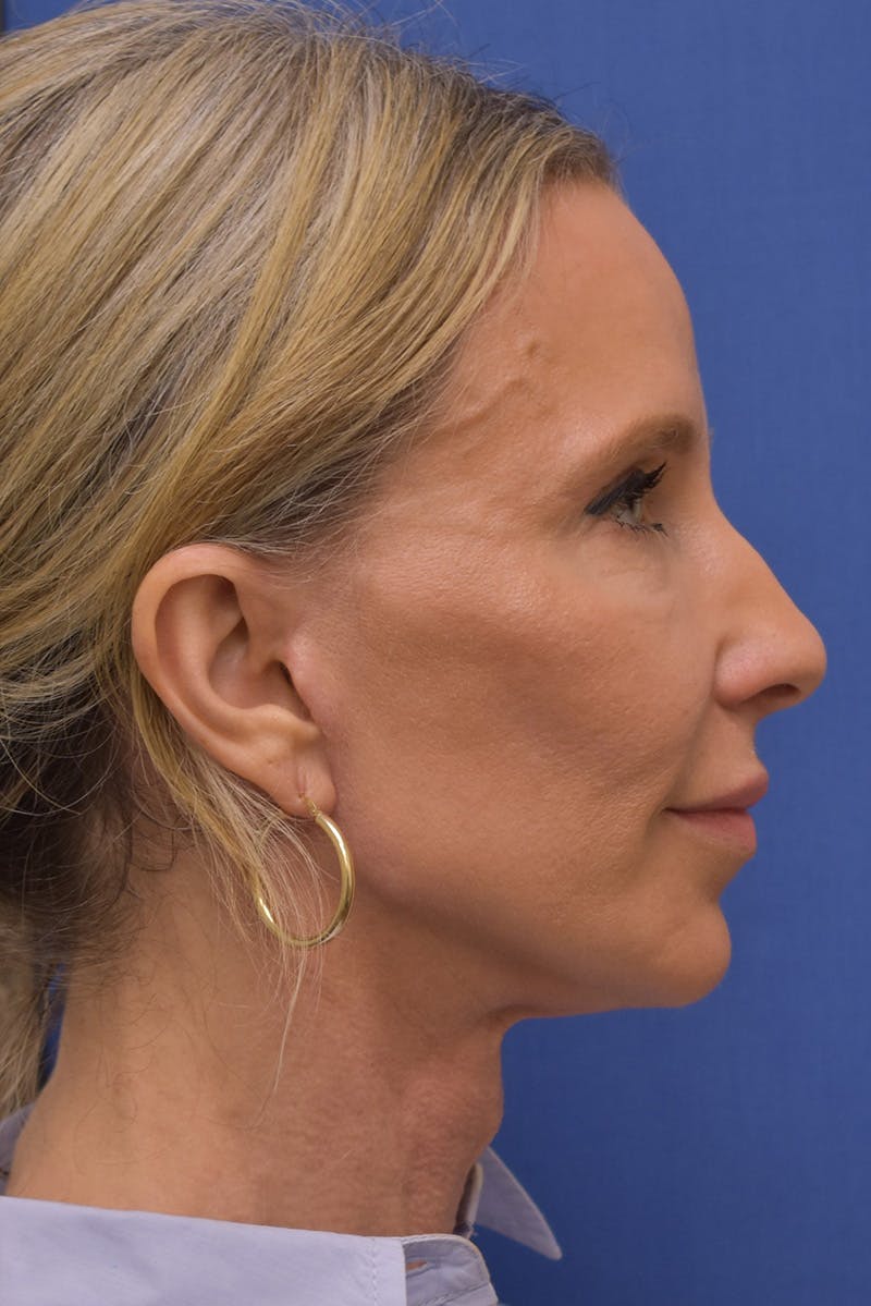 Necklift Before & After Gallery - Patient 408053 - Image 8