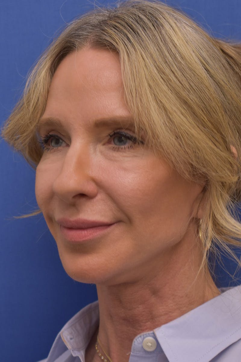 Necklift Before & After Gallery - Patient 408053 - Image 10