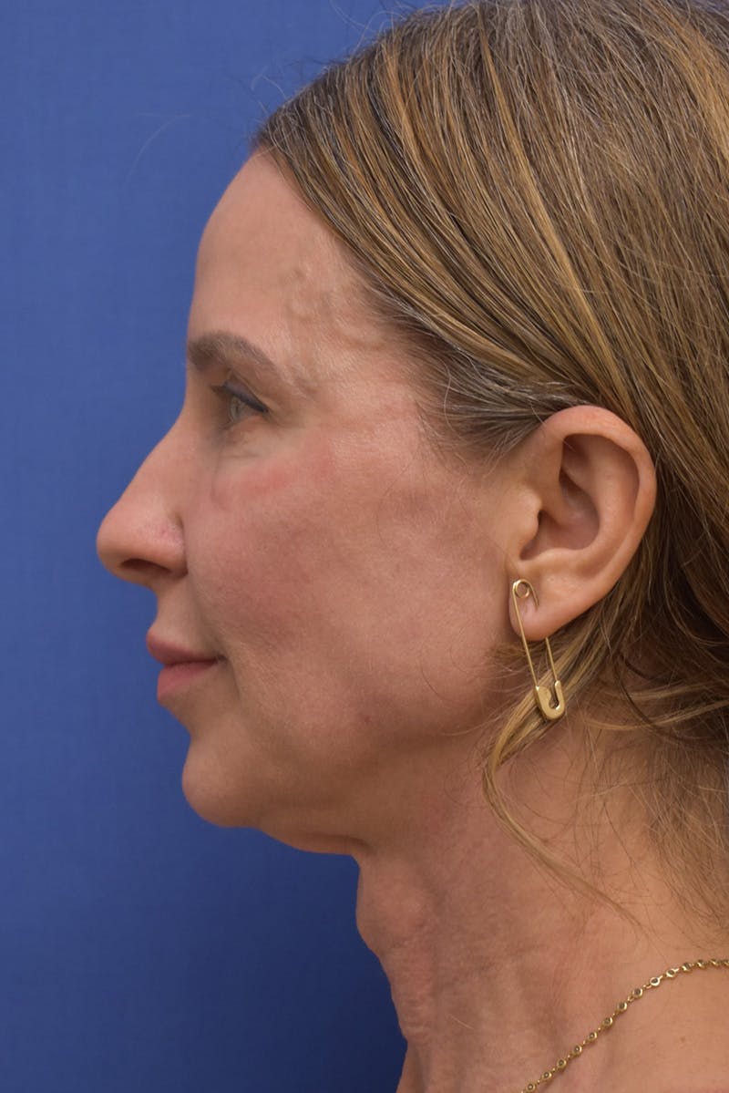 Necklift Before & After Gallery - Patient 408053 - Image 11