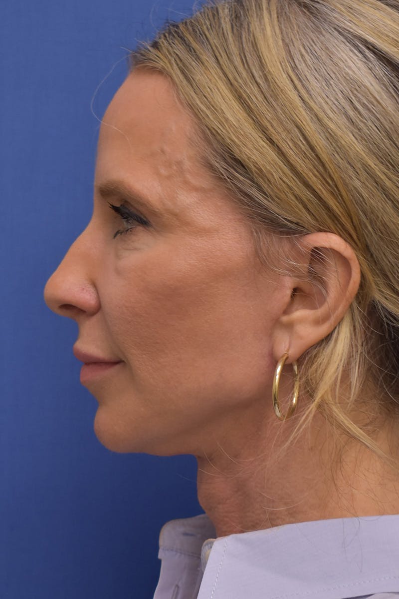Necklift Before & After Gallery - Patient 408053 - Image 12