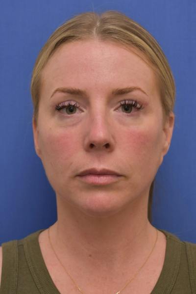 Blepharoplasty Before & After Gallery - Patient 360999 - Image 2