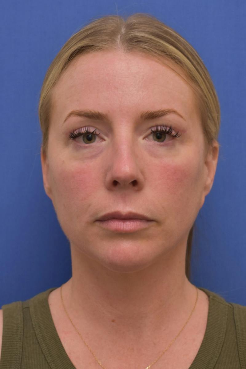 Blepharoplasty Before & After Gallery - Patient 360999 - Image 2