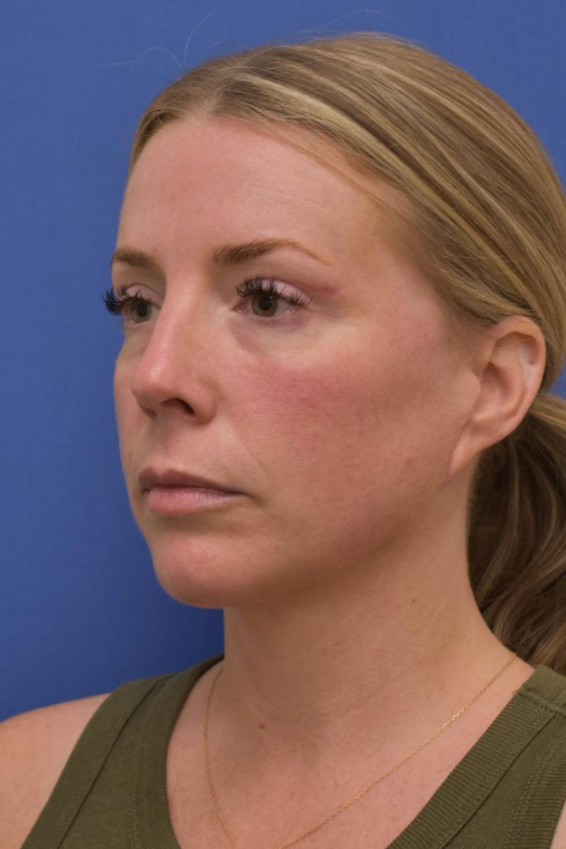 Blepharoplasty Before & After Gallery - Patient 360999 - Image 10