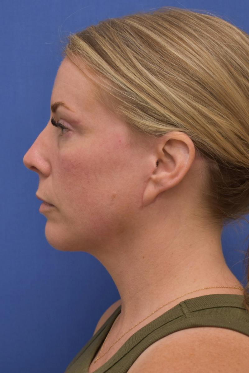 Blepharoplasty Before & After Gallery - Patient 360999 - Image 12
