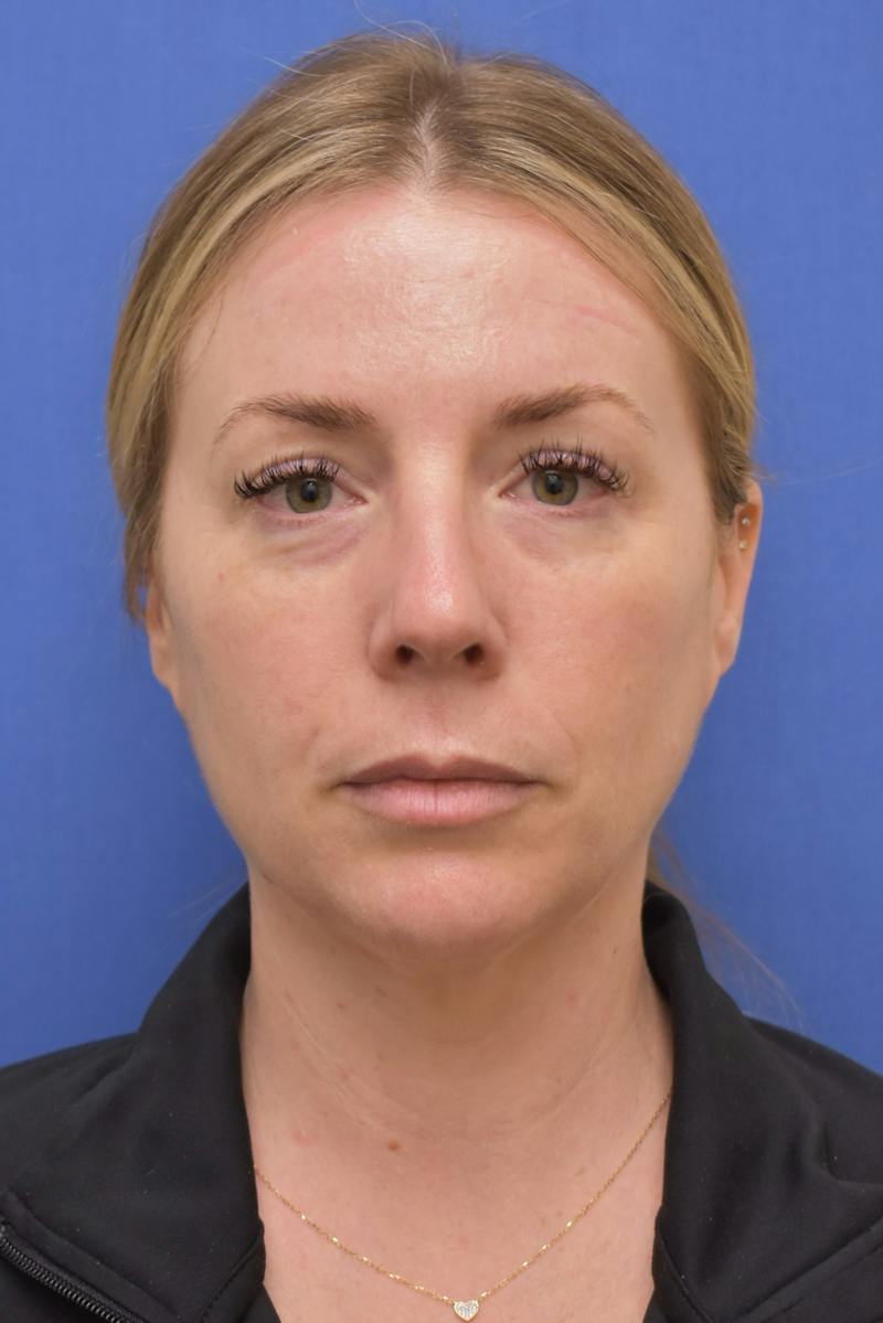 Blepharoplasty Before & After Gallery - Patient 360999 - Image 1