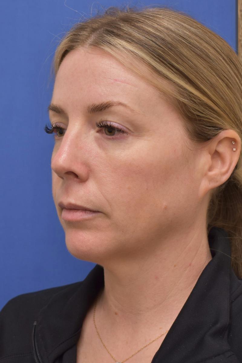 Blepharoplasty Before & After Gallery - Patient 360999 - Image 9